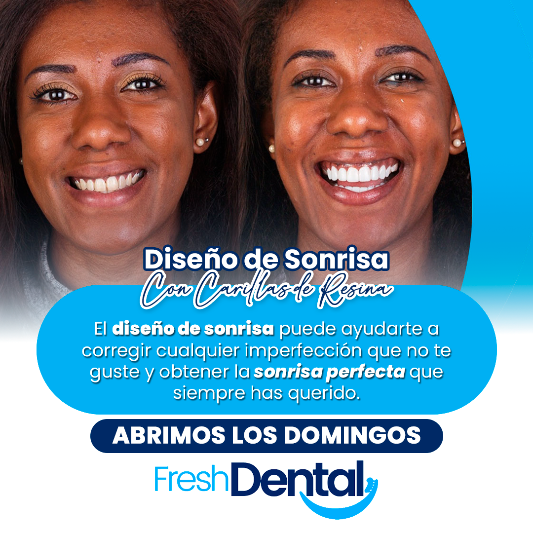 banner-1-carillas-resina-sonrisa-natural-fresh-dental-atlanta